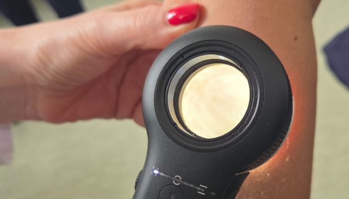 Pregled dermoskopom 1