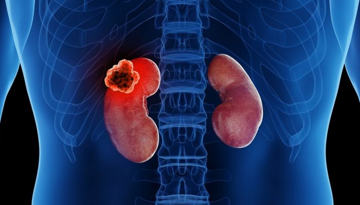 Rak-bubrega-2