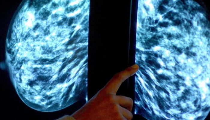 novi-lijek-usporava-napredovanje-neizljecivog-raka-dojke-dojka_67f8b78b2c274